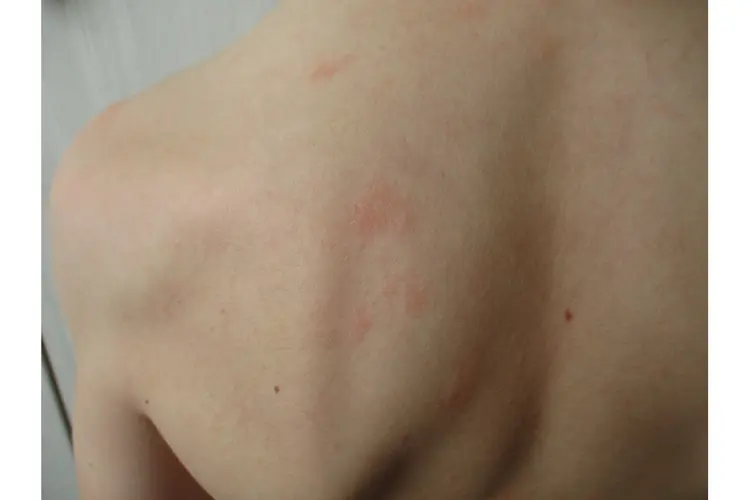 Alles over rode bultjes zonder jeuk, uitgelegd door Dr. Jetske